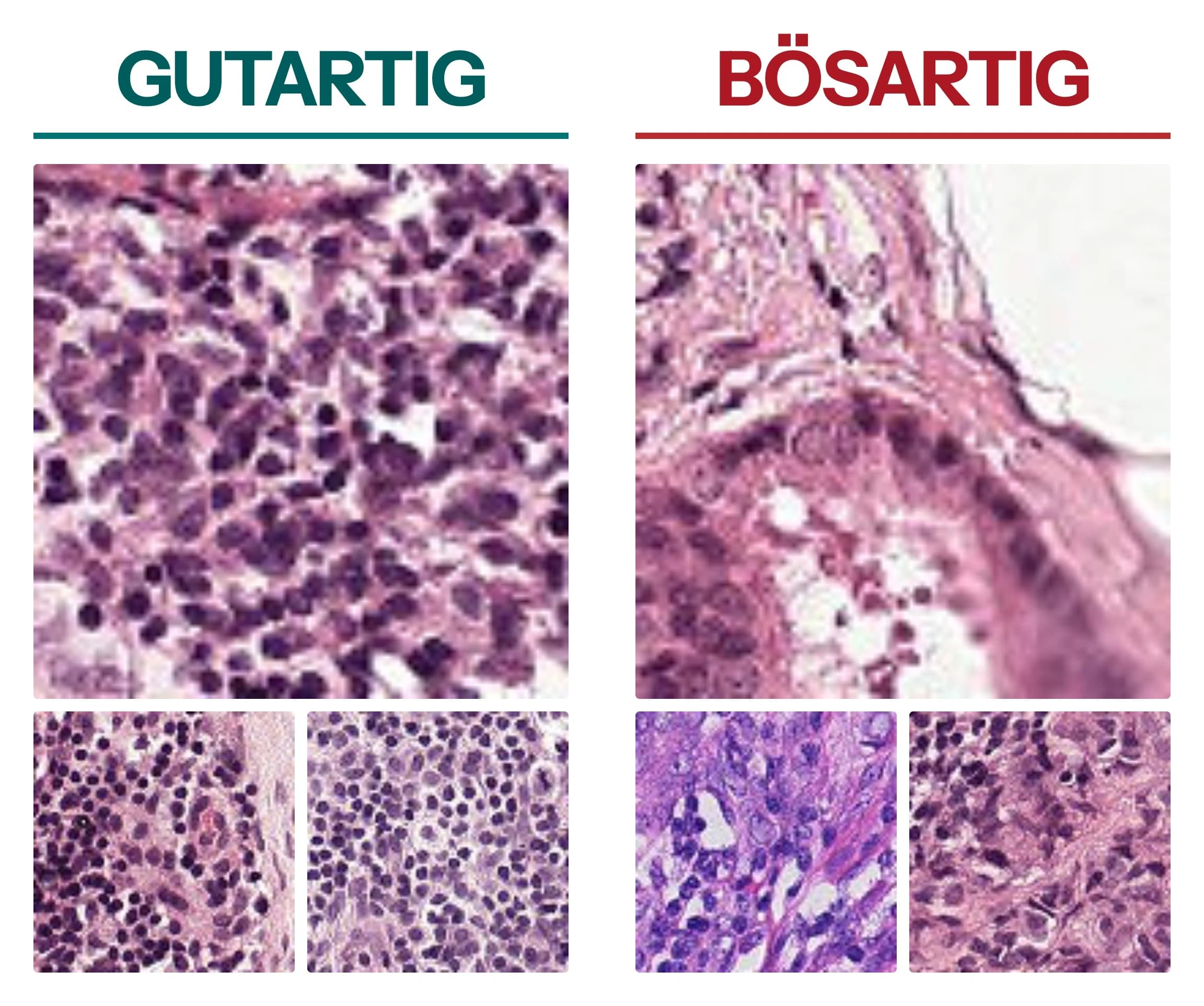 Sechs eingefärbte Lymphknoten-Gewebeausschnitte, links drei gutartige und rechts drei bösartige. Die gutartigen zeigen kleine, gleichmäßig große dunkle Zellkerne, die bösartigen größeren Zellen unterschiedlicher Größe, die sich zu Gruppen zusammenlagern und von rosafarbenem Bindegewebe durchzogen sind.