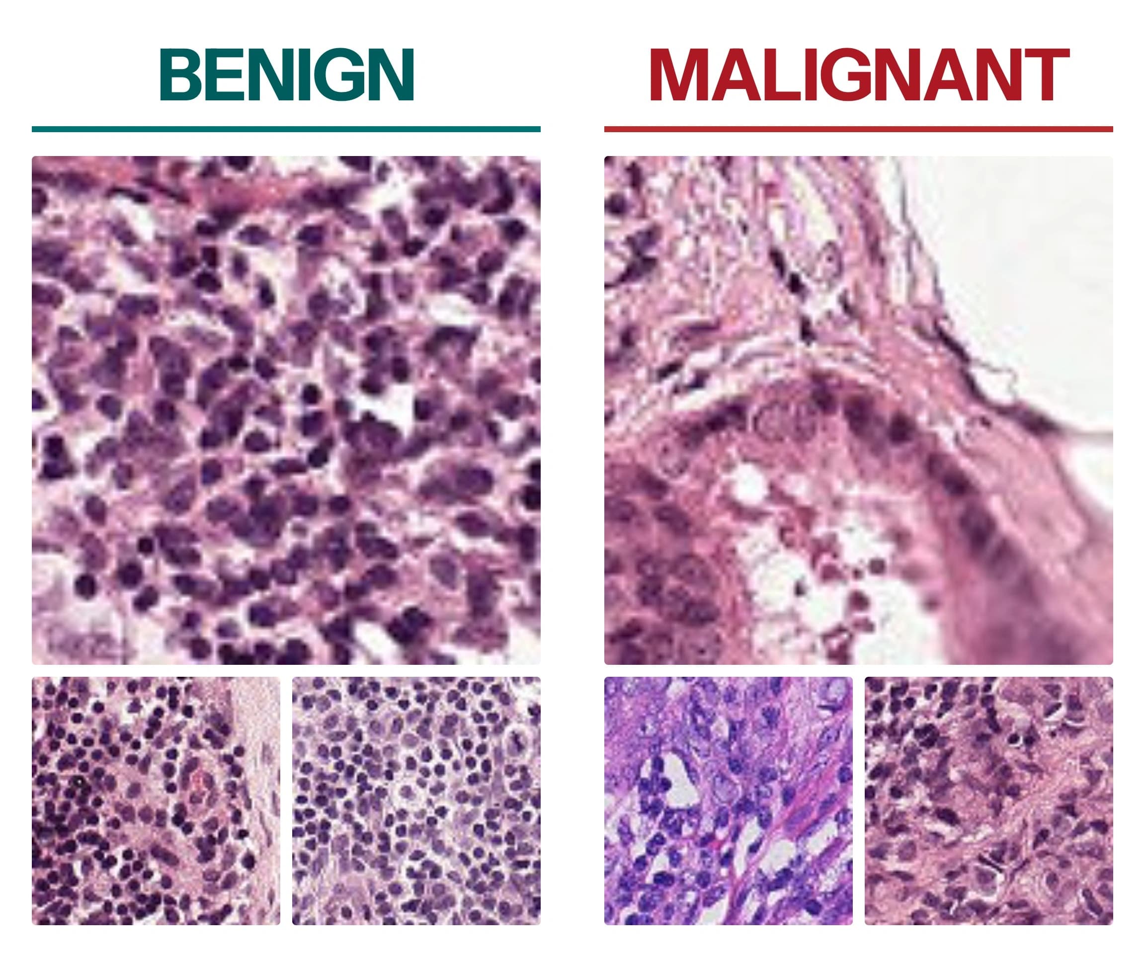 Six stained lymph node tissue patches, three labelled benign on the left and three labelled malignant on the right. The benign ones show small, evenly sized dark nuclei; the malignant ones show larger cells of varying size, grouped into clusters and streaked with pink fibrous tissue.